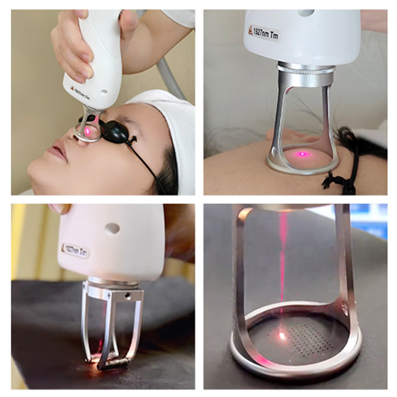 Advanced Fractional Skin Rejuvenation System Non-Ablative 1927nm Thulium Laser for Scar Repair and Pigmentation Treatment