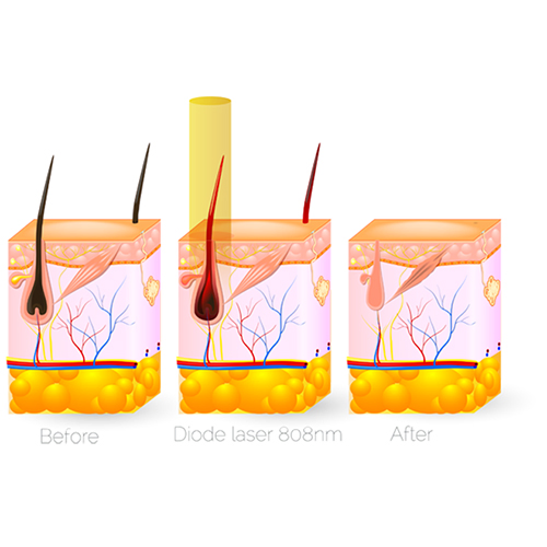 IPL Hair Removal Machine Skin Rejuvenation Machine Opt Laser System Painfree Hair Removal IPL Portable IPL Hair Removal