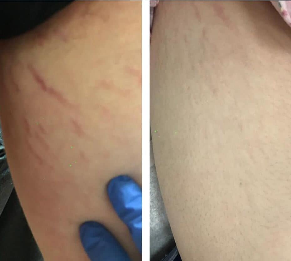 High-Performance Secret RF Microneedling System for Youthful Skin