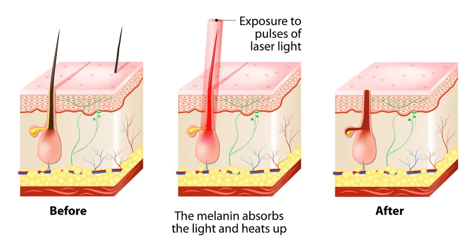 Diode Laser Technology