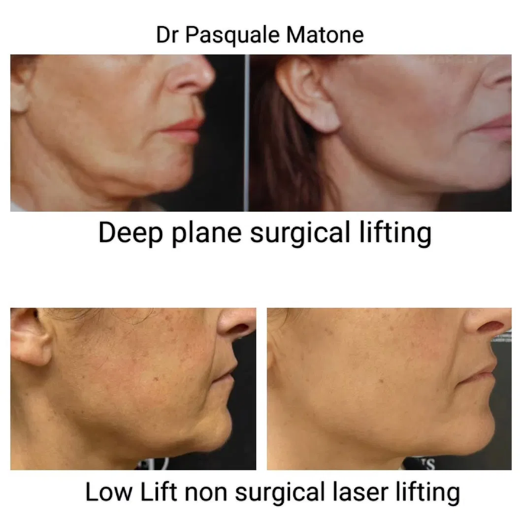 Before and After Treatment Result 4