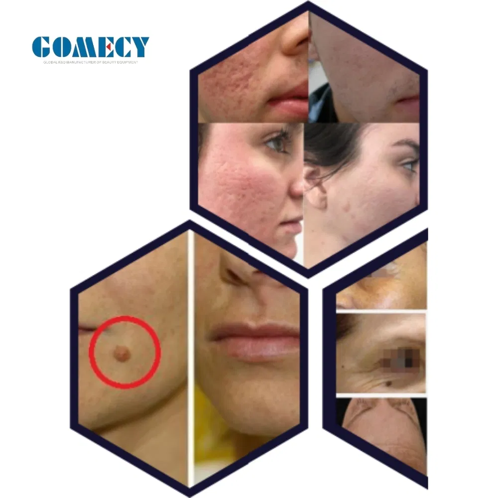 Fractional Fotona 4D Laser Machine Fractional CO2 Laser System