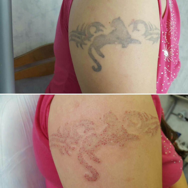 Treatment 2