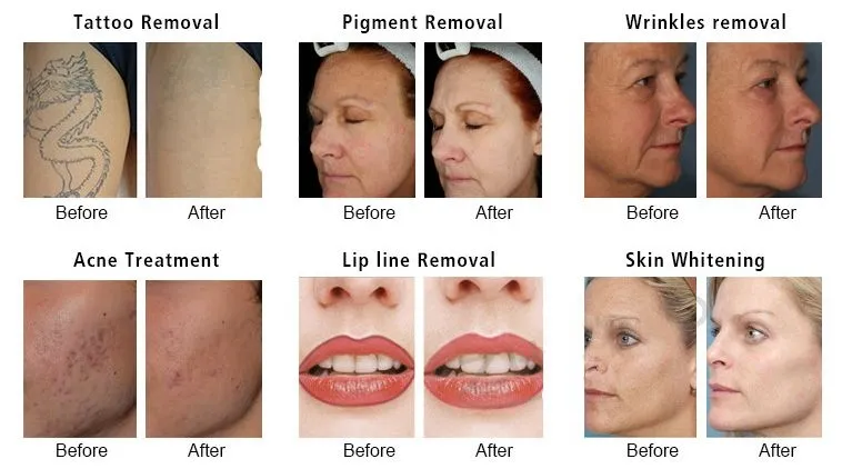 Before and After Results