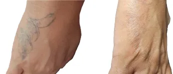 Treatment Result 5