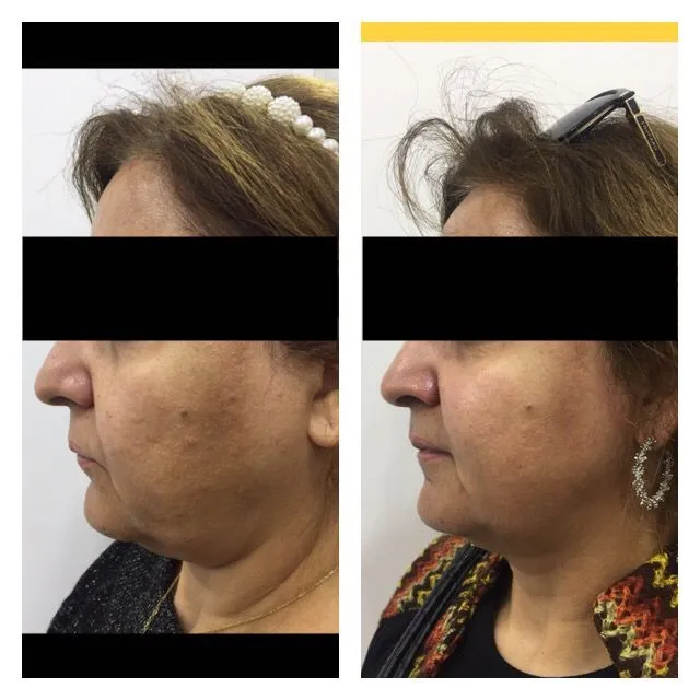 Before and After Treatment Result 3