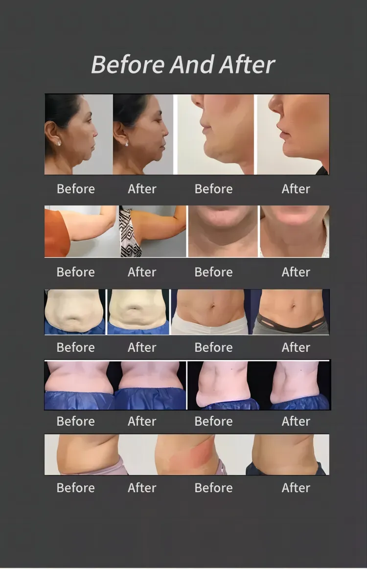 Before and After