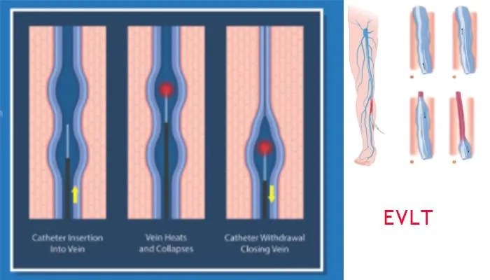 EVLA Treatment