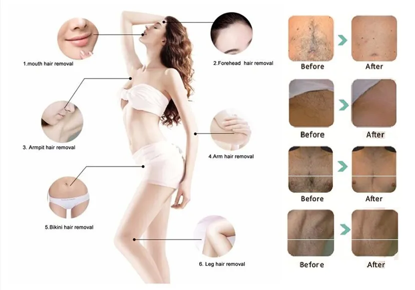 808nm Diode Laser Hair Removal Device