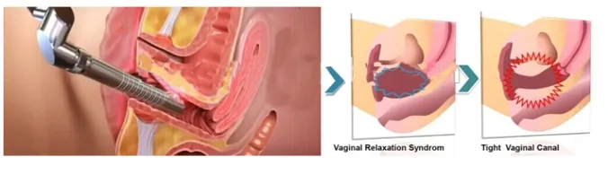 Vaginal Probe Principle