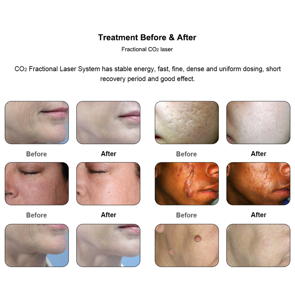Find an Agent Dermatology Equipment Compact Fractional Laser Fast Treatment Skin Rejuvenation Fractional-co2-laser