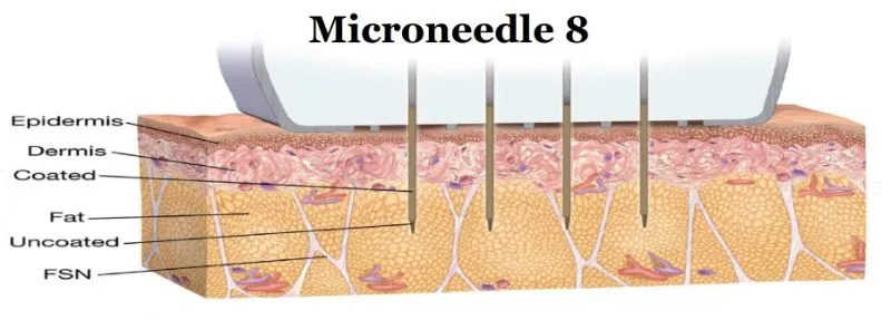 RF Technology Treatment