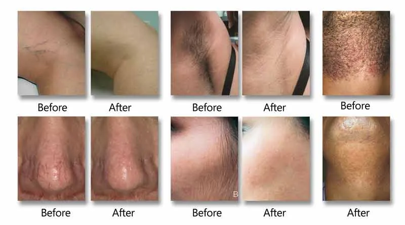 Before and After Treatment