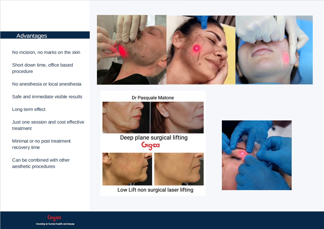 Endo Laser Lipolysis System for Skin Tightening and Facial Contouring Minimally Invasive Laser for Skin Tightening