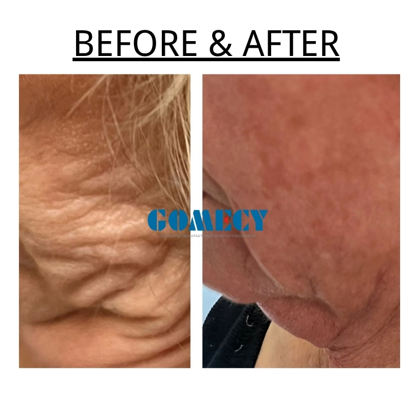Portable 1470nm 980nm Endolaser Acne Treatment Lipolysis Face Lift Weight Loss Desktop Style Opt Opt Fiber Plddevlt Endolifting
