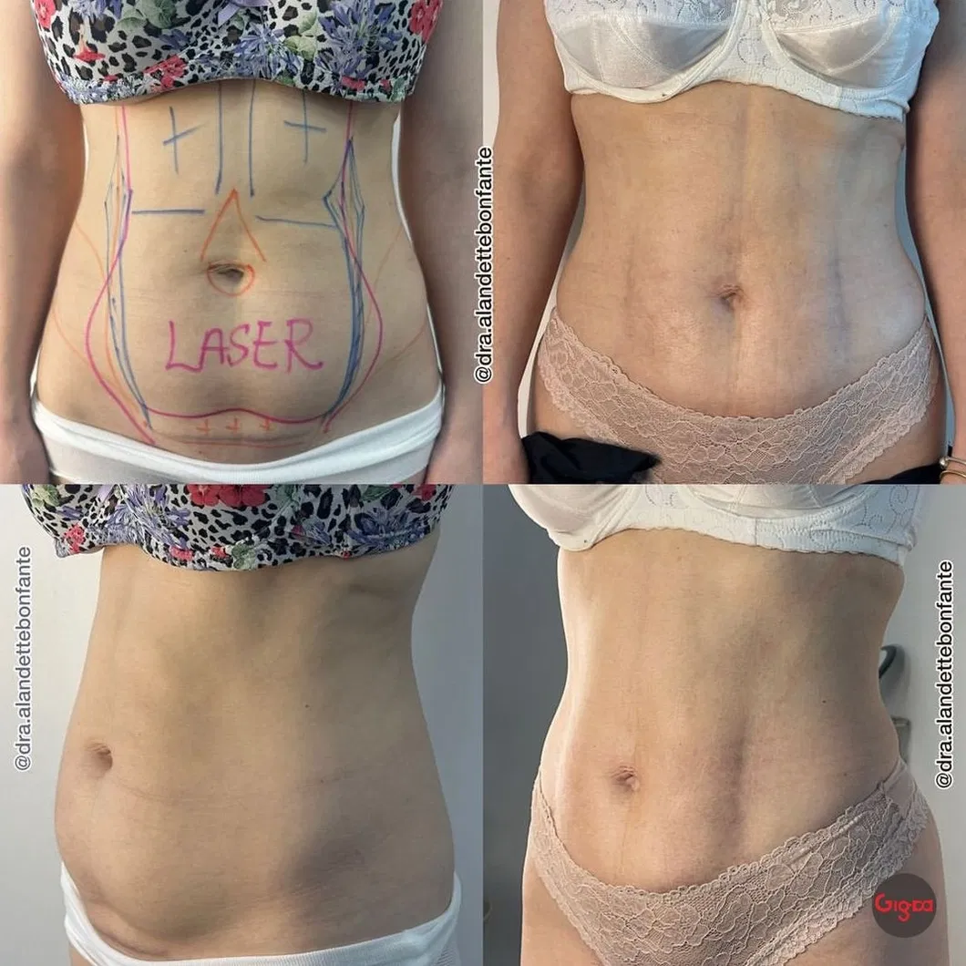 Before and After Treatment Result 2