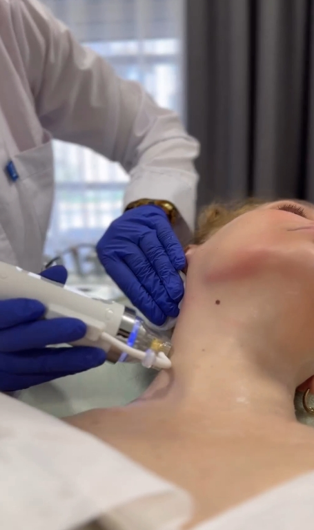 High-Performance Secret RF Microneedling System for Youthful Skin