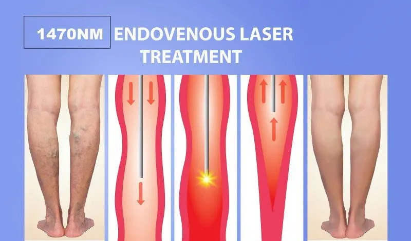 Hemorrhoids Surgery