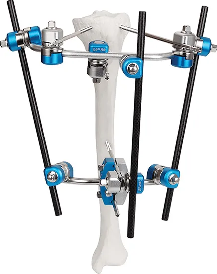 Tibia External Fixator