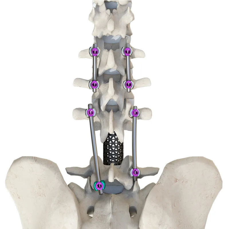 Spinal Fixation Application 2