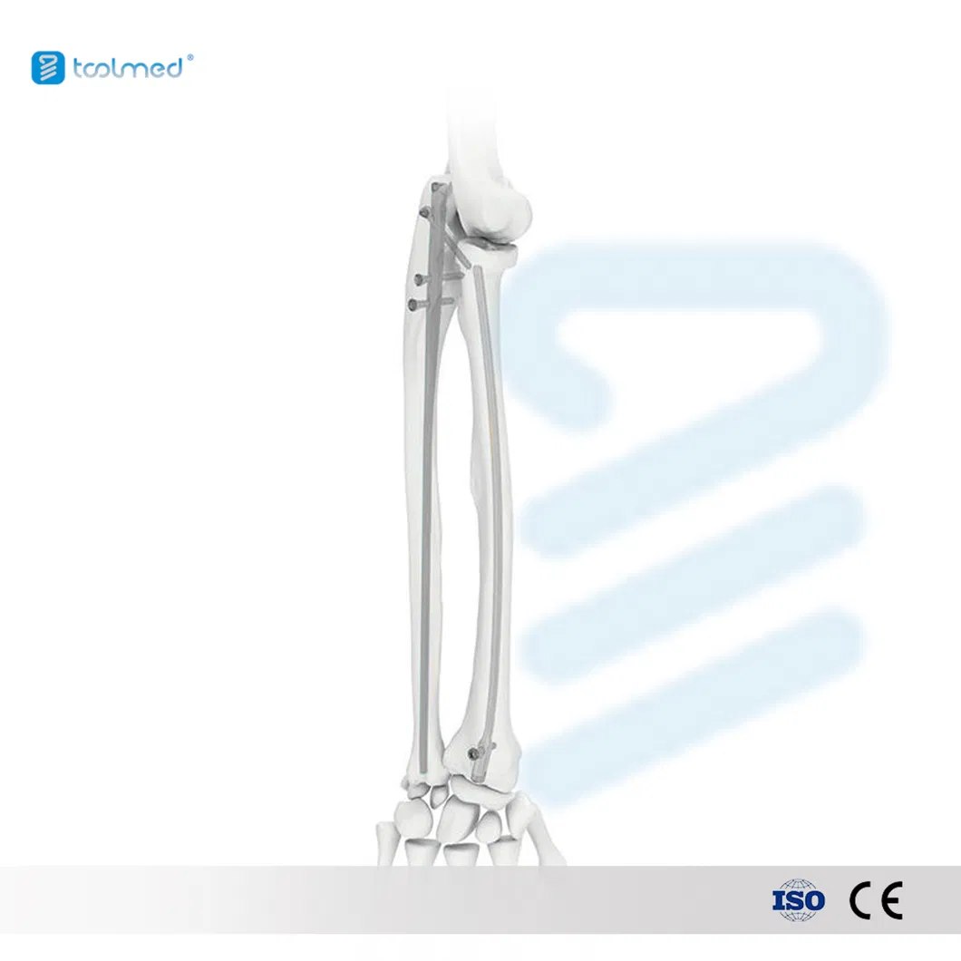 Ulna Intramedullary Nail