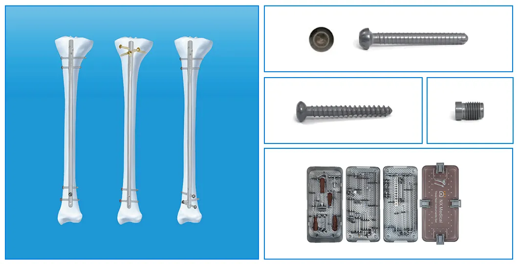 Tibial Nail System Details
