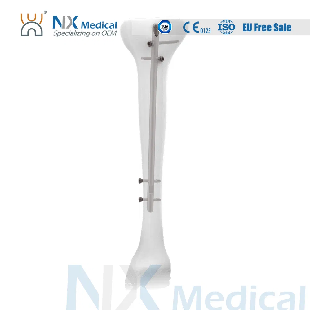 Nx Medical Orthopedic Implant Trauma Proximal Tibial Interlocking Intramedullary Nail China Factory