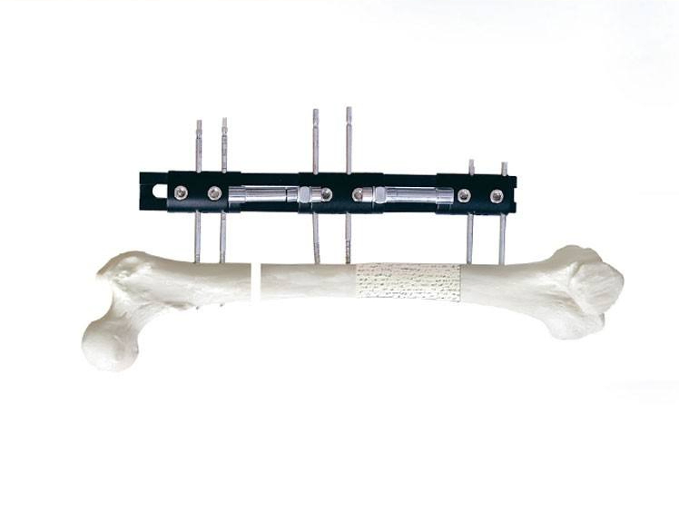 Orthopedic External Fixation Lrs Limb Reconstruction System External Fixator