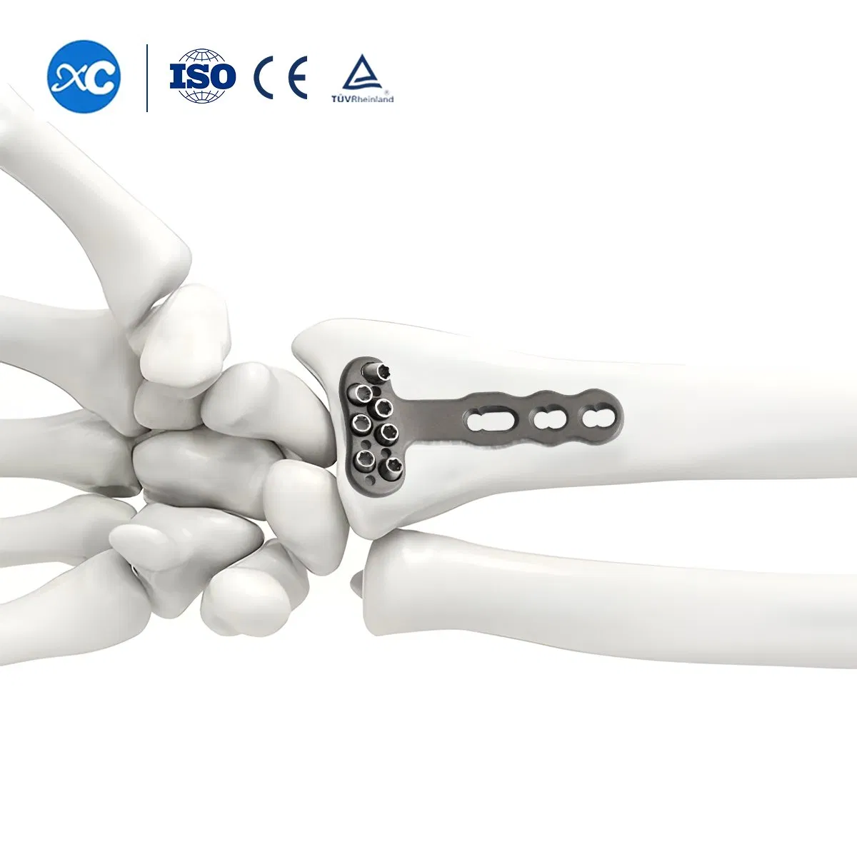 Fracture Surgery Titaniumdistal Radius Locking Plate Orthopedic Implant