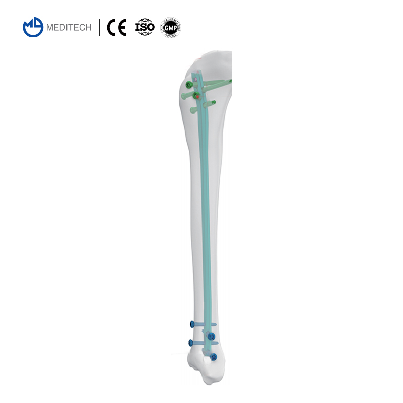 Titanium Orthopedic Surgical Implant Suprapatellar Approach Tibial Intramedullary Nail