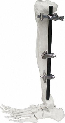 Strong External Fixator for Bone Fixation, White &amp; Black, Titanium Alloy