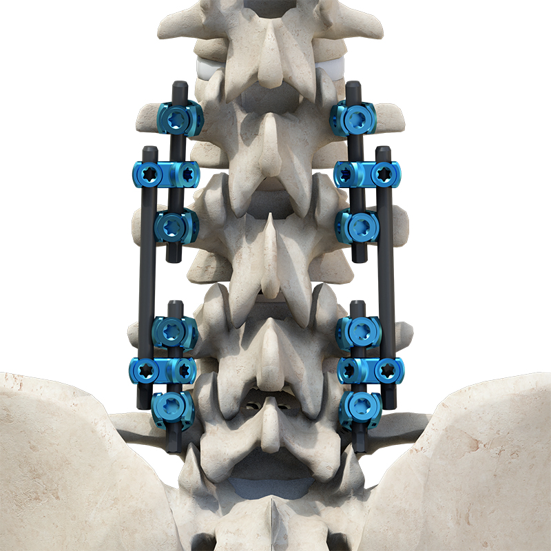 Advanced Narrow Blade Lamina Hook for Thoracolumbar Fusion