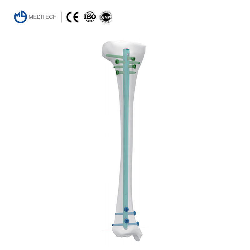 Titanium Orthopedic Surgical Implant Suprapatellar Approach Tibial Intramedullary Nail