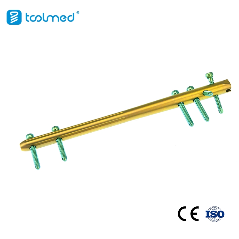 Orthopaedic Implant Trauma Expert-Level Femoral Retrograde Intramedullary Nail