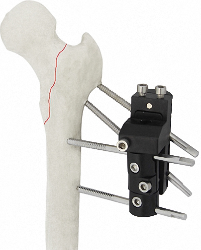 Titanium Alloy White &amp; Black Bone External Fixator