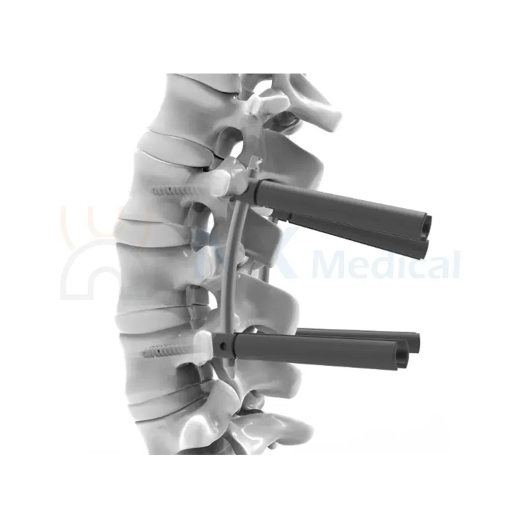 Nx Medical Orthopedic Implant Cannulated Bone Cement Pedicle Screw Spine Bone Fixation