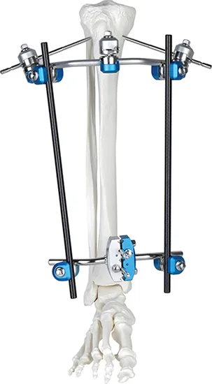 External Fixator Kit