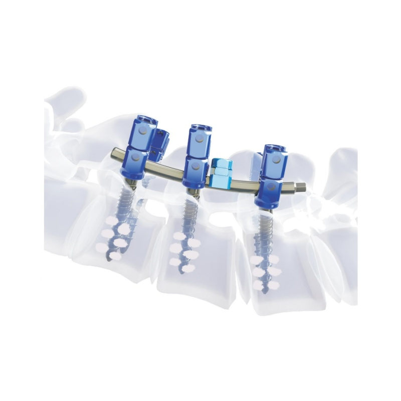 Medical Cement Spine Cannulated Pedicle Screw