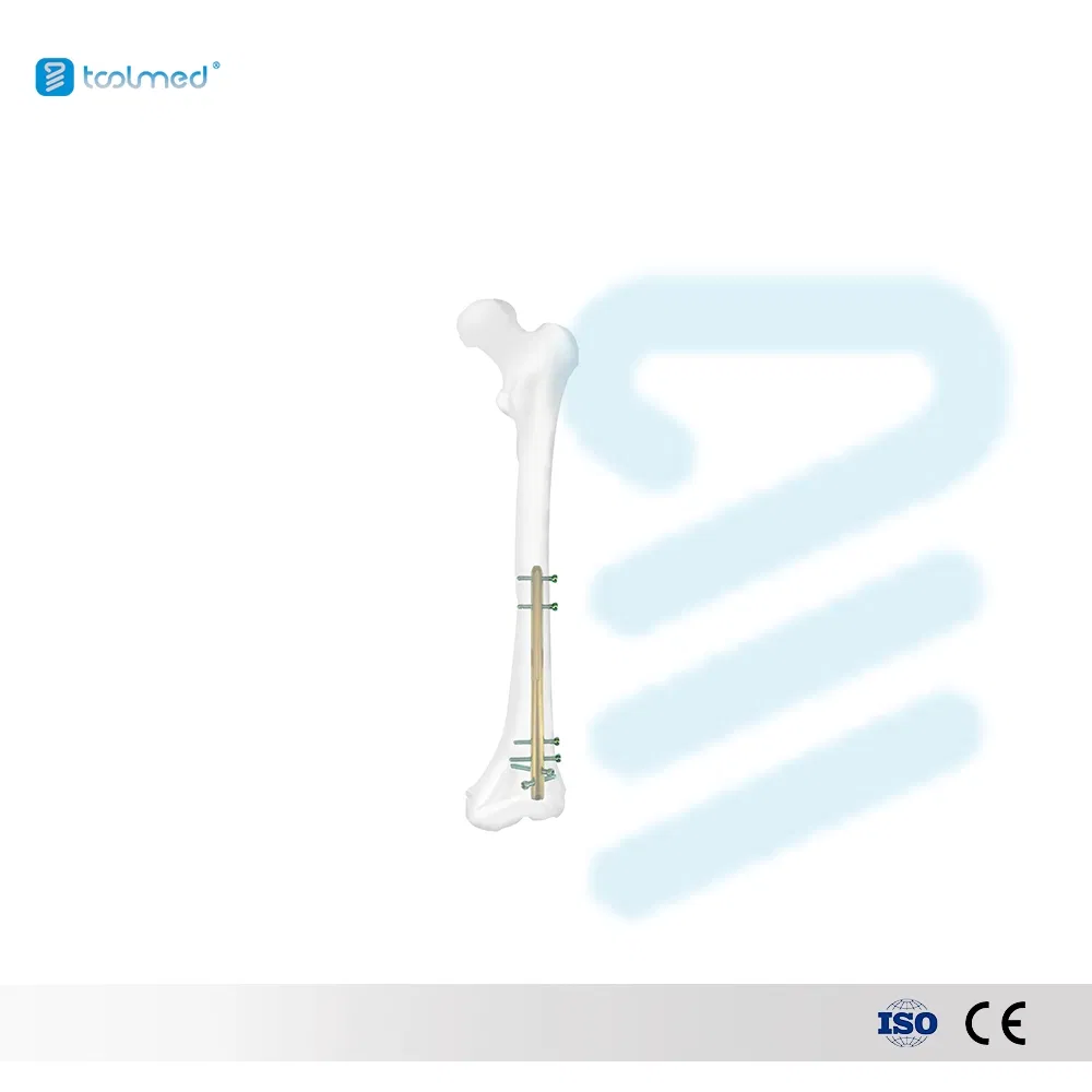 Expert Osteosintesis Intramuslary Proximal Femoral Nail Pfna Intramedullary Interlocking Femur Nail Fusion Cage 10*220