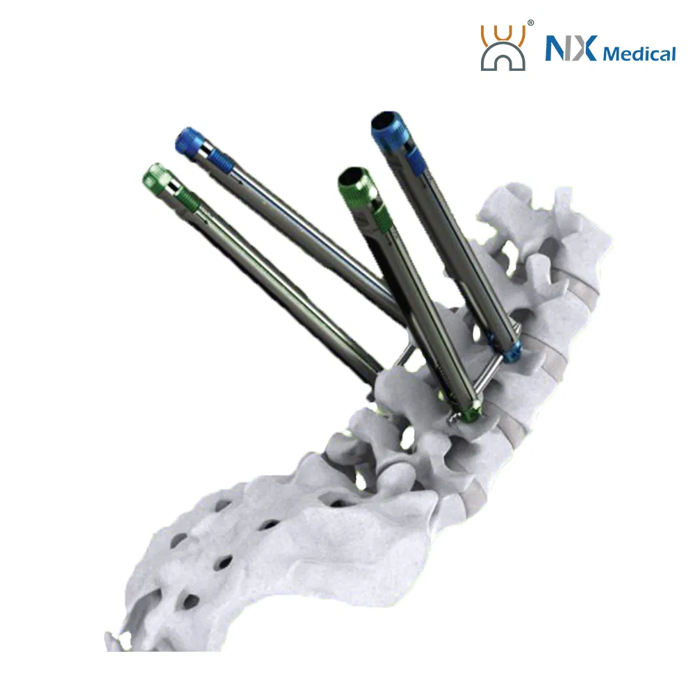 Nx Medical Titanium Cannulated Bone Cement Pedicle Screw 5.5mm Orthopedic Internal Fixation