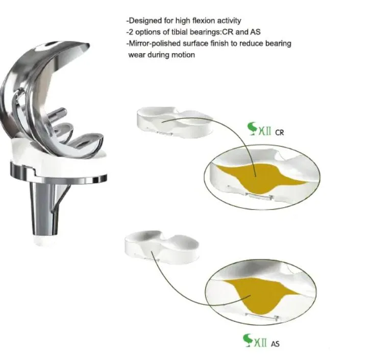 Orthopedic Implant Complex Primary Total Knee Replacement