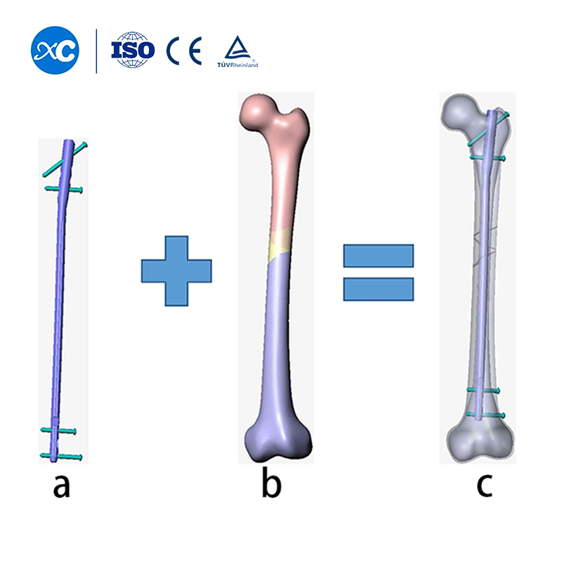 Best Corrosion Resistance Intramedullary Nail for Orthopetic