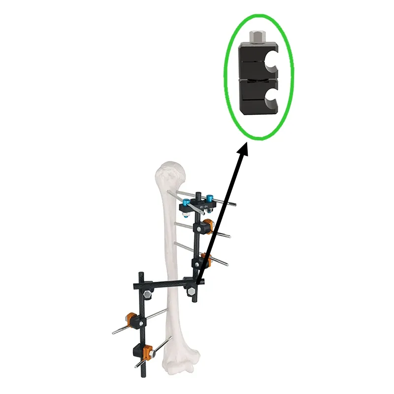 External Fixator Detail