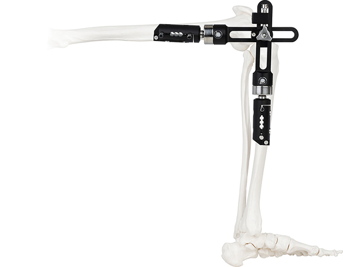 External Fixation Interjoint Fixator