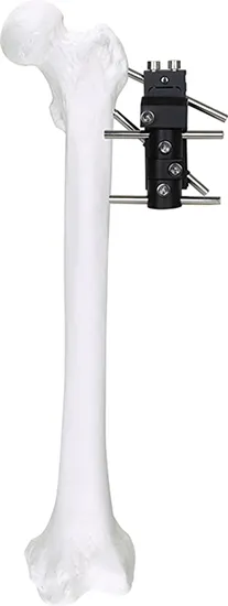 Pertrochanterie Fixator