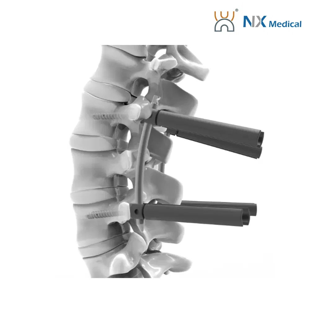 Nx Medical Spine Implant Cannulated Bone Cement Pedicle Screw for Spine Deformity