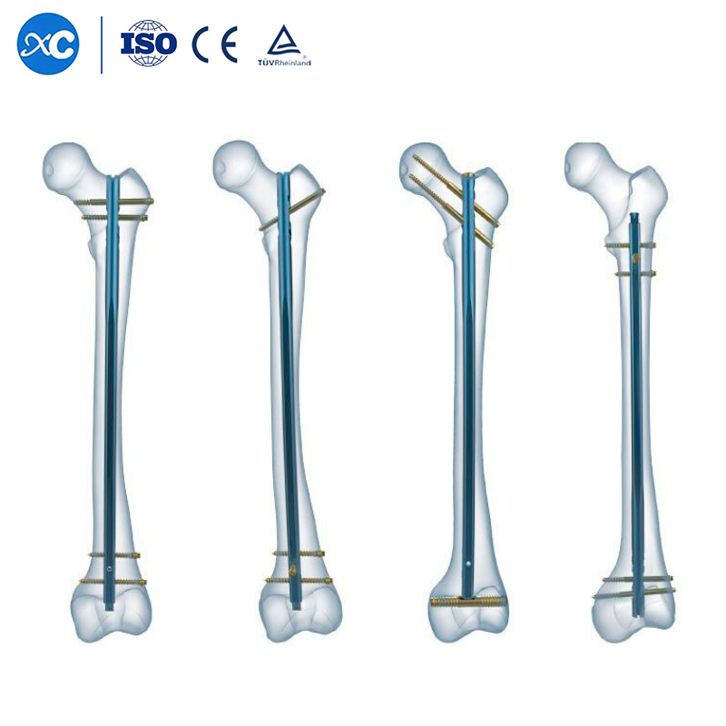 Best Corrosion Resistance Intramedullary Nail for Orthopetic