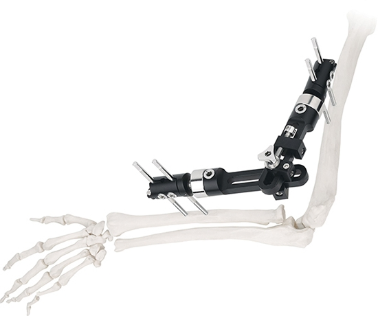 External Fixation Interjoint Fixator