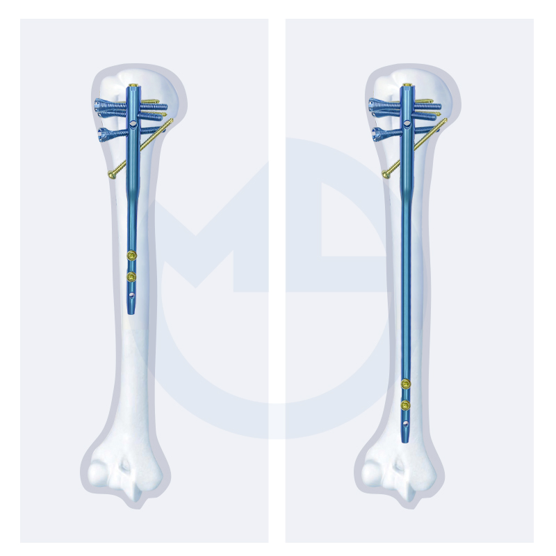 Medical Supply Orthopedic Implant Titanium Interlocking Humerus Nail Multi-Lock Humeral Intramedullary Nail