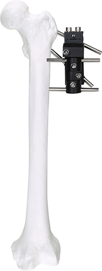 External Fixation Interjoint Fixator